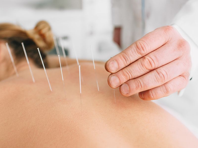 Acupuntura para dor muscular