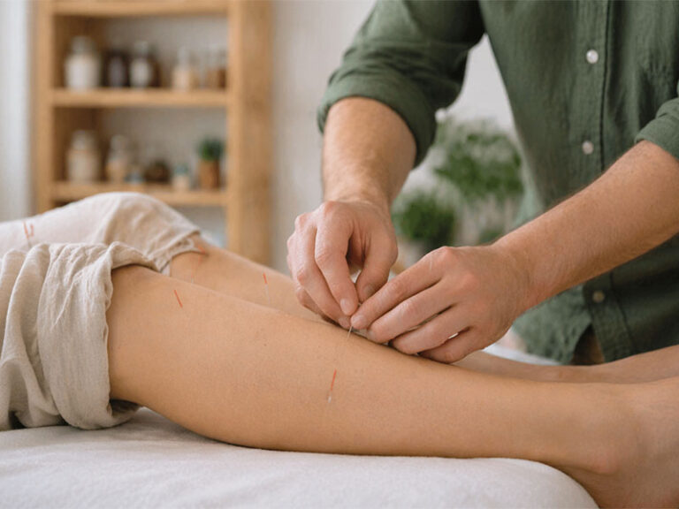 acupuntura-fibromialgia